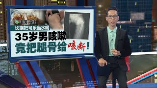 长期把可乐当水喝   35岁男咳嗽竟把腿骨给咳断 | 新闻报报看 03/06/2024