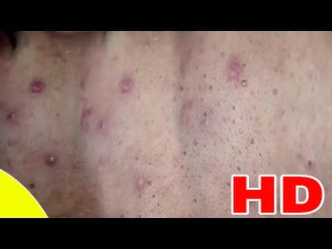 Cystic Acne ، Pimples And Blackheads Extraction Treatment On Face!! |(PART )