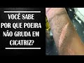 Você sabe por que poeira não gruda em cicatriz? Enfermagem Educacional