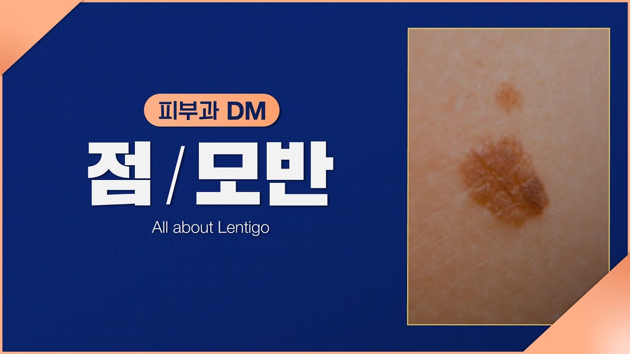 [피부과] 점. 발생 원인과 유형, 치료 방법 알아보기! - YouTube