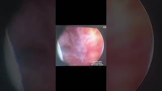 Hysteroscopic uterine septal excision