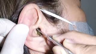 Removing Woman&#39;s Big Black Earwax | Ear is Clogged!