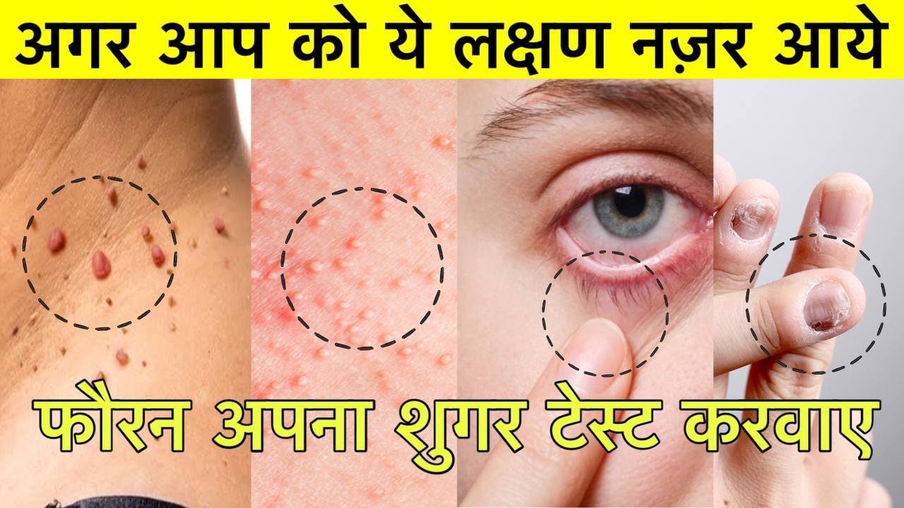 Diabetes Symptoms | शुगर के लक्षण | Symptoms of High Blood Sugar - Dr. Vivek Joshi