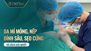 Phẫu thuật chỉnh sửa mí mắt có tình trạng nếp đính sâu, sẹo cứng, da mỏng