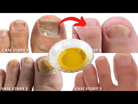 CURE Toenail Fungus for Less than $2/ HAVE NAIL FUNGUS? YOU NEED TO BE DOING THIS ! toenail fungus