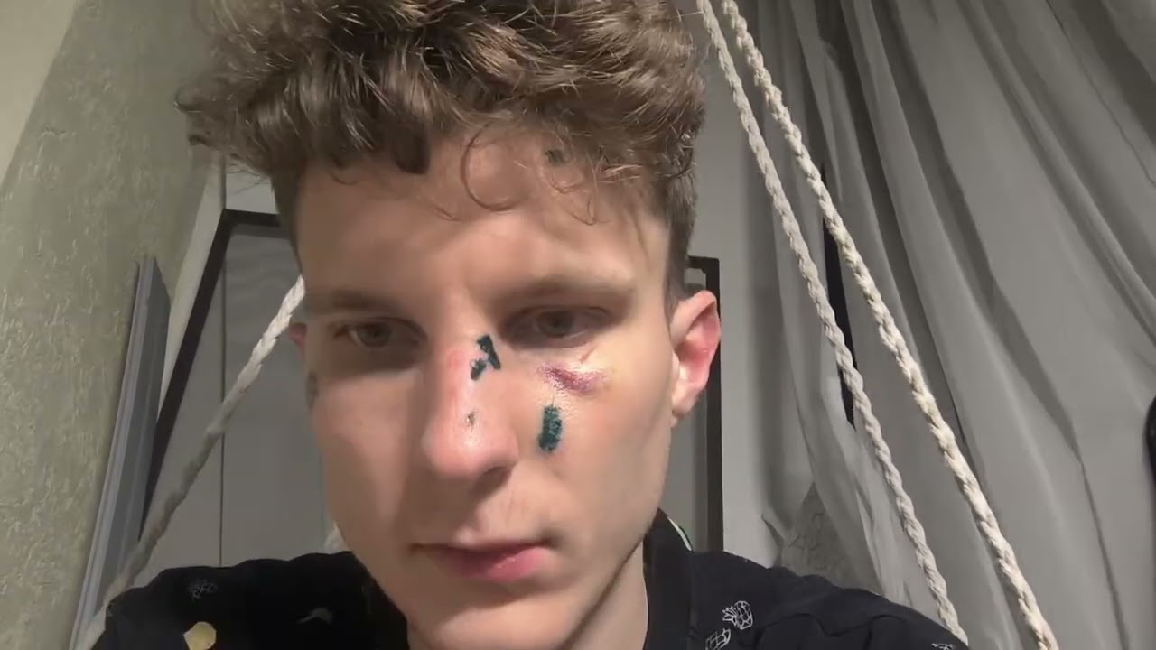 День 54. Сняли швы 