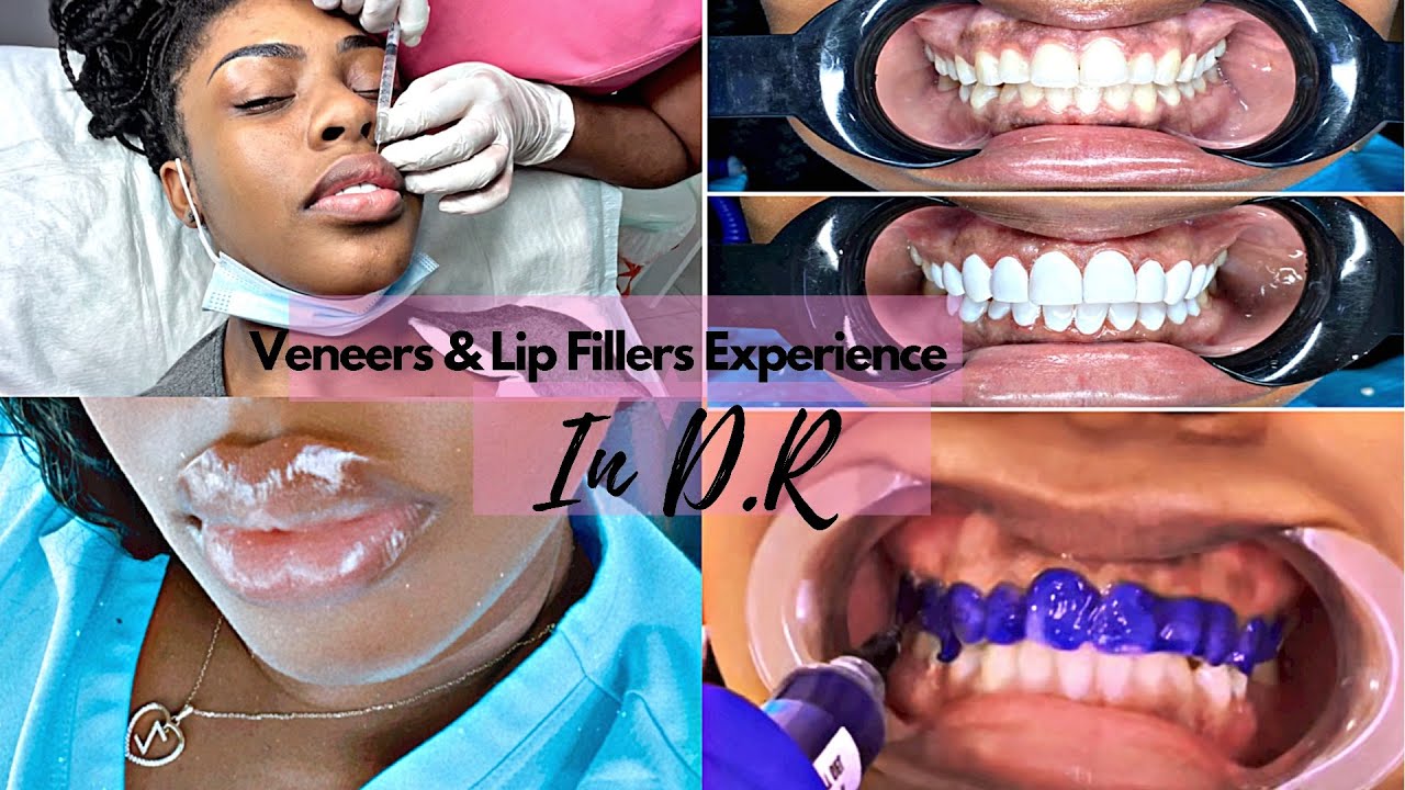 Getting Veneers & Lip Filler in the Dominican Republic ZEE ALLURE