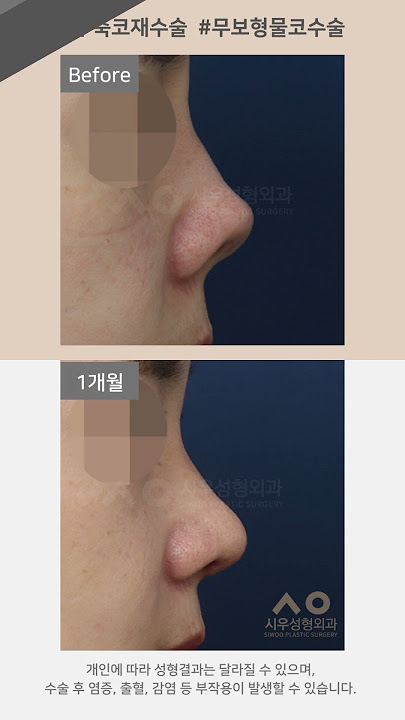시우Tv Siwoo Plastic Surgery - Youtube