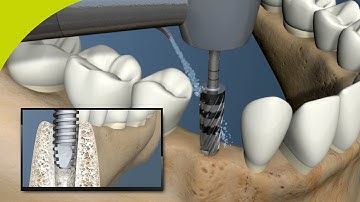 Versah Densah Bur Introduction Animation Video