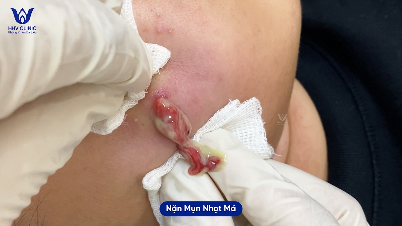 Tổng hợp những ca mụn nhọt mủ ở vùng Má - Tại phòng khám da liễu HHV Clinic.