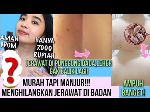 CUMA 7 RIBU! TIPS MENGHILANGKAN JERAWAT BADAN (JERAWAT DI PUNGGUNG, DADA,PERUT)