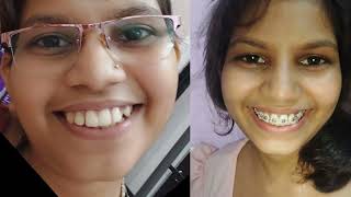 My Braces Journey Begins 2023| Daanton me Braces/Clip Lagwana |GP48| G Vlog | Gargi Parija