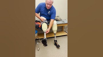 Union Orthotics & Prosthetics Co. Patient Ken Weidaw and  Versafoot 2 Prosthetics