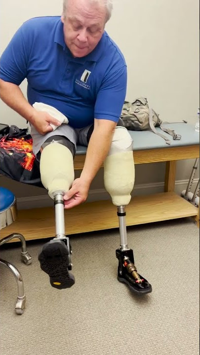 Union Orthotics & Prosthetics Co. Patient Ken Weidaw and Versafoot 2 Prosthetics