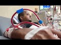 علاج بإمكانيات محدودة في مستشفى الأقصى بدير البلح وسط قطاع غزة نتيجة تعطل المولدات الكهربائية