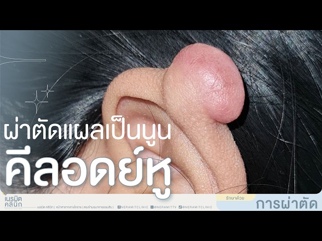 ผ่าตัดแผลเป็นนูน คีลอยด์หู EP.345 @หมอปุ๊ เนรมิตคลินิก โคราช