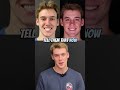 Crazy changes after jaw alignment.