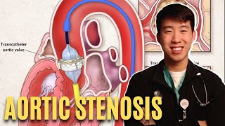 Everything You Need To Know About Aortic Stenosis