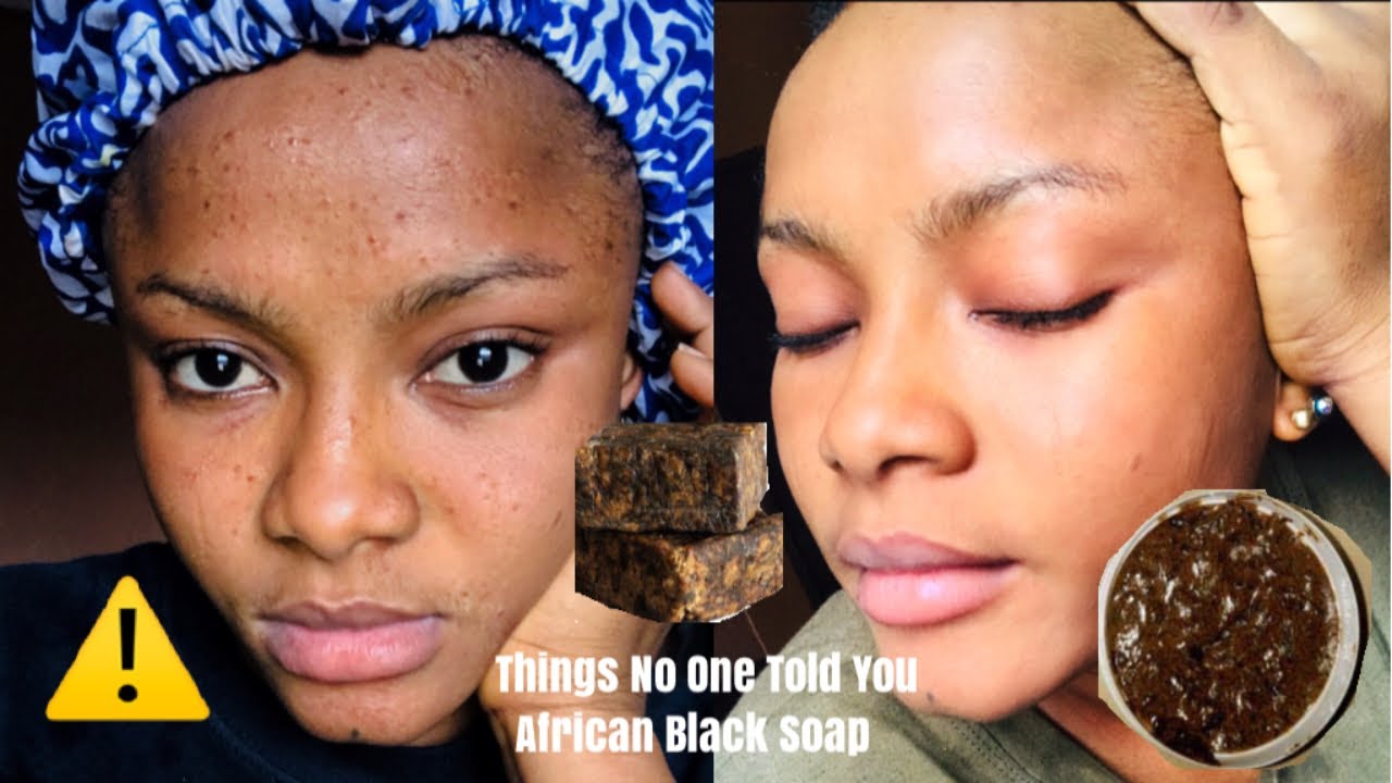hyperpigmentation soap for black skin