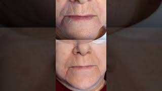 Plasmapen Timișoara