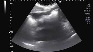 Ultrasound Video showing wall thickening of the stomach walls.