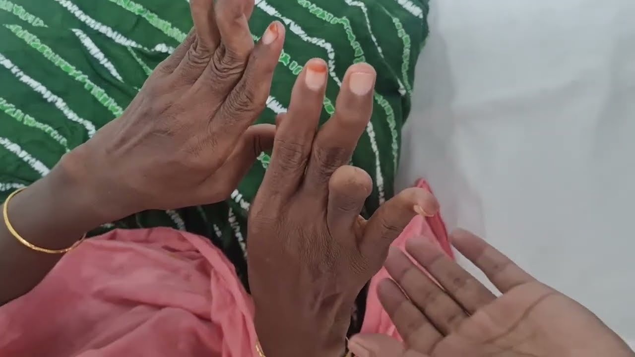 Typical Picture of Rheumatoid Deformity