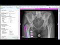 Proximal Femoral Osteotomy  Deformity Correction Planning ...