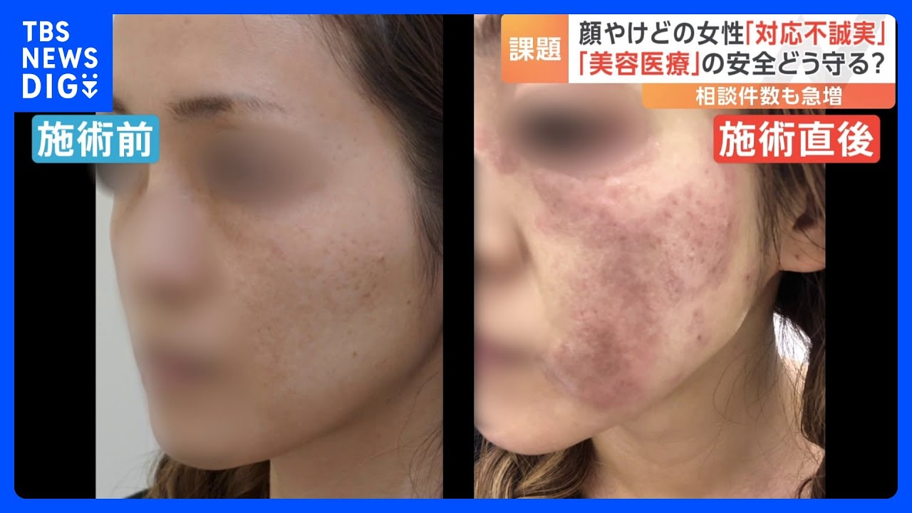 美容医療」の安全どう守る シミ治療でやけども トラブルの背景に経験