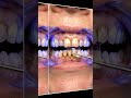 Yellow Teeth Gone in Minutes #TeethWhitening #DentalCare #Shorts
