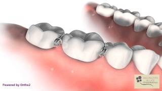 Tooth Separator - Spring