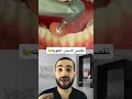 تسوية الاسنان في ٦٠ ثانية 