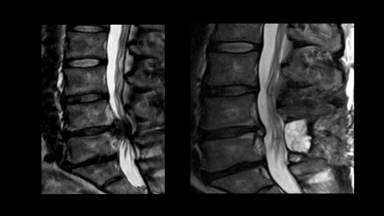 Cauda Equina Syndrome With Normal Mri Imaging - the meta pictures
