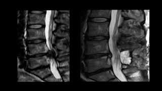 Presentation - A Neurological Perspective of Cauda Equina Syndrome