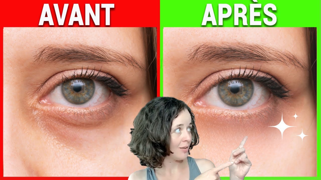 Bye Bye CERNES ET POCHES - Acupression Efficace en 5 points !