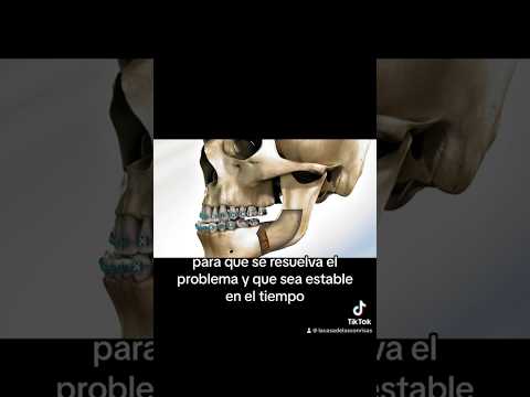 #tipsdentales 💥Ejemplos de cirugías maxilofaciales con brackets!! 😬