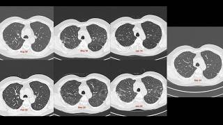 Case of the Day - 223 - Stage II-III sarcoidosis - waxing and waning over 4 years and 7 scans