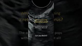 Endometriosis is EASY to see with a retroverted uterus! Check it out! Uterus Position On Ultrasound Anteverted Vs Retroverted Explained