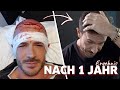 Ein Jahr nach meiner Haartransplantation | Ergebnis & Fazit