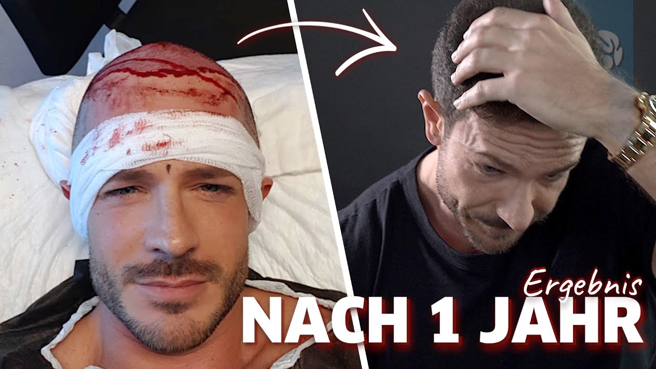 Update Ein Jahr nach meiner Haartransplantation | Ergebnis \u0026 Fazit
