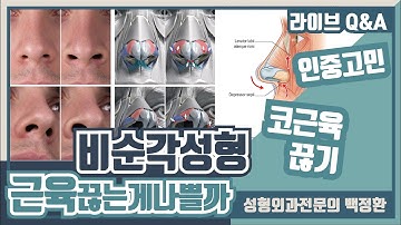 코 근육을 끈지 않고 비순각 수술이 가능한가요?