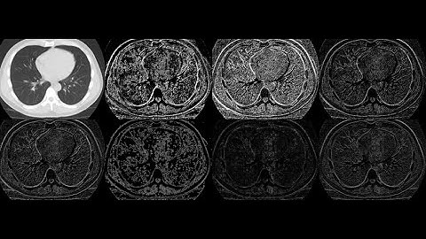 COVID-19 Detection on Chest X-Ray and CT Scan Images Using Multi-image Augmented Deep Learning Model