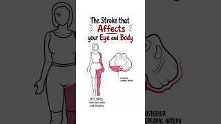 Neurology Insights: The Stroke that Affects your Eye and Body #webersyndrome #stroke #neurology