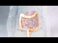 Understanding the jpouch surgical procedure