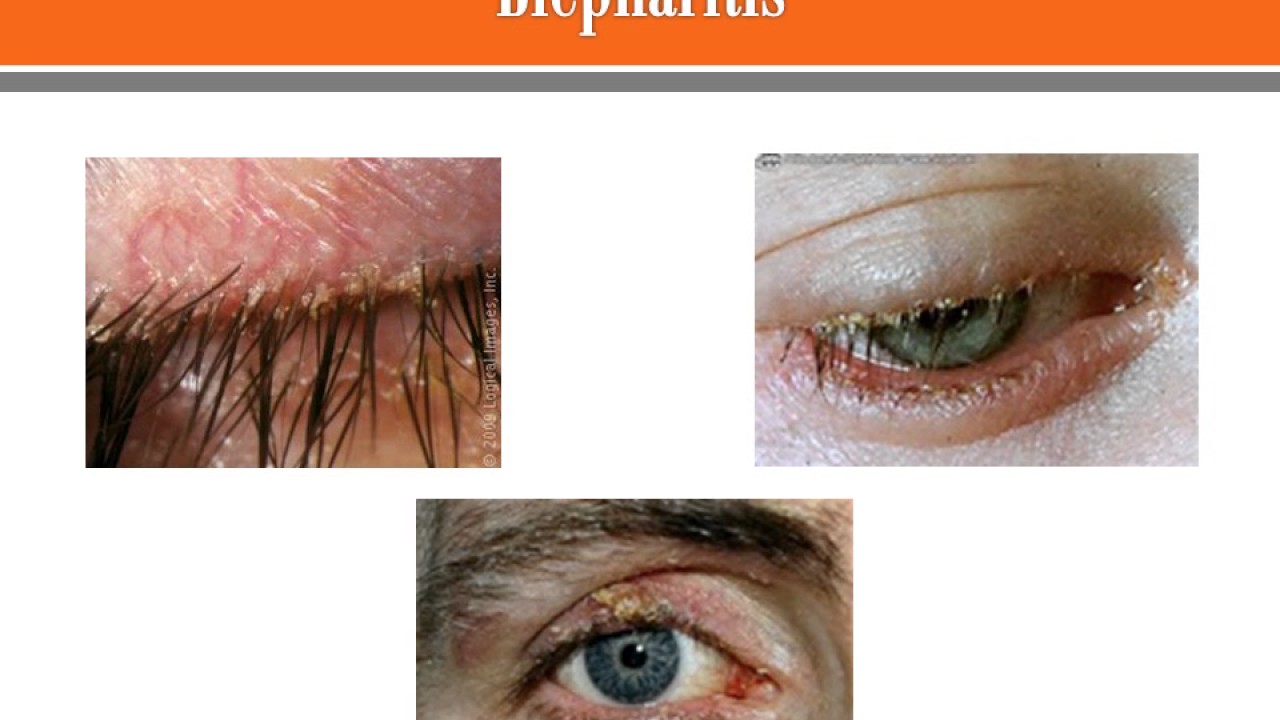 Blepharitis 