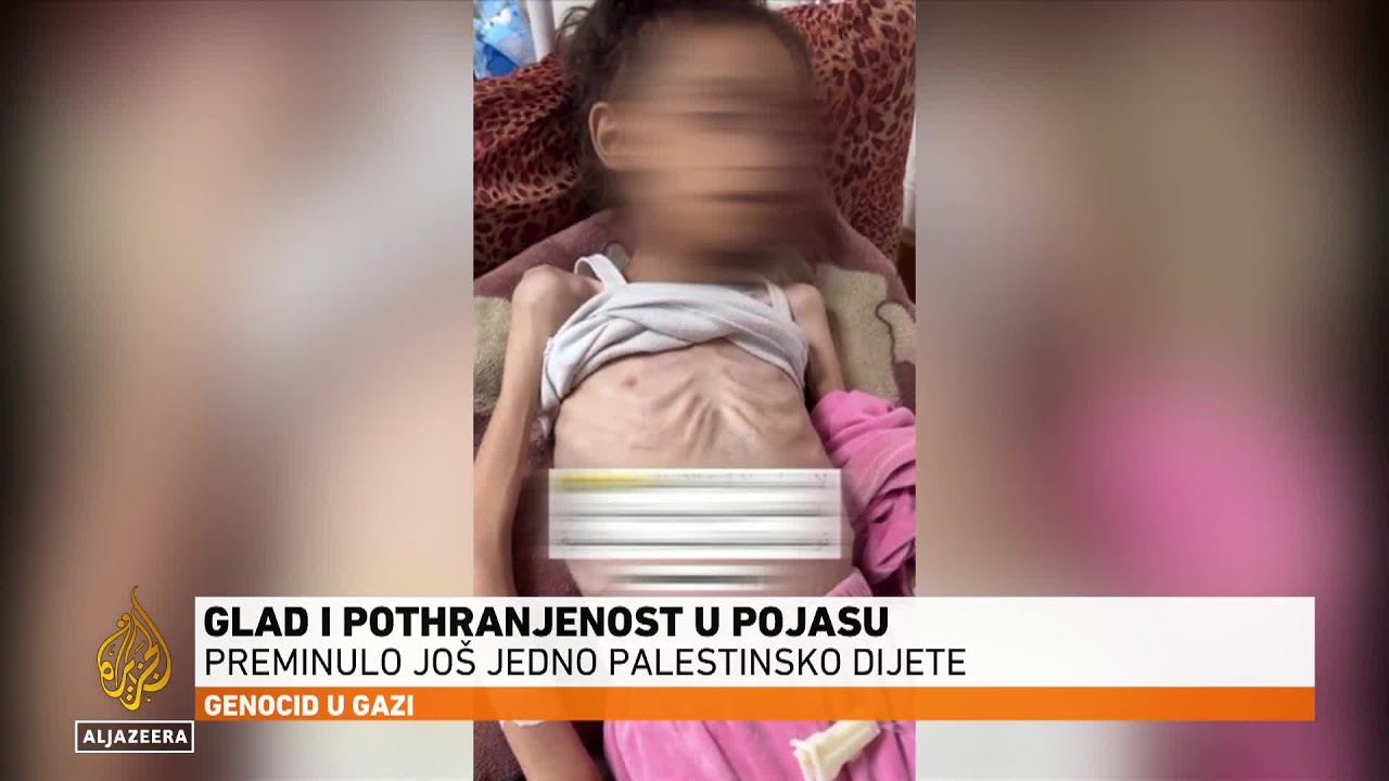وفاة طفل فلسطيني آخر بسبب سوء التغذية