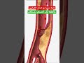 خثرة دموية وتصلب الشرايين