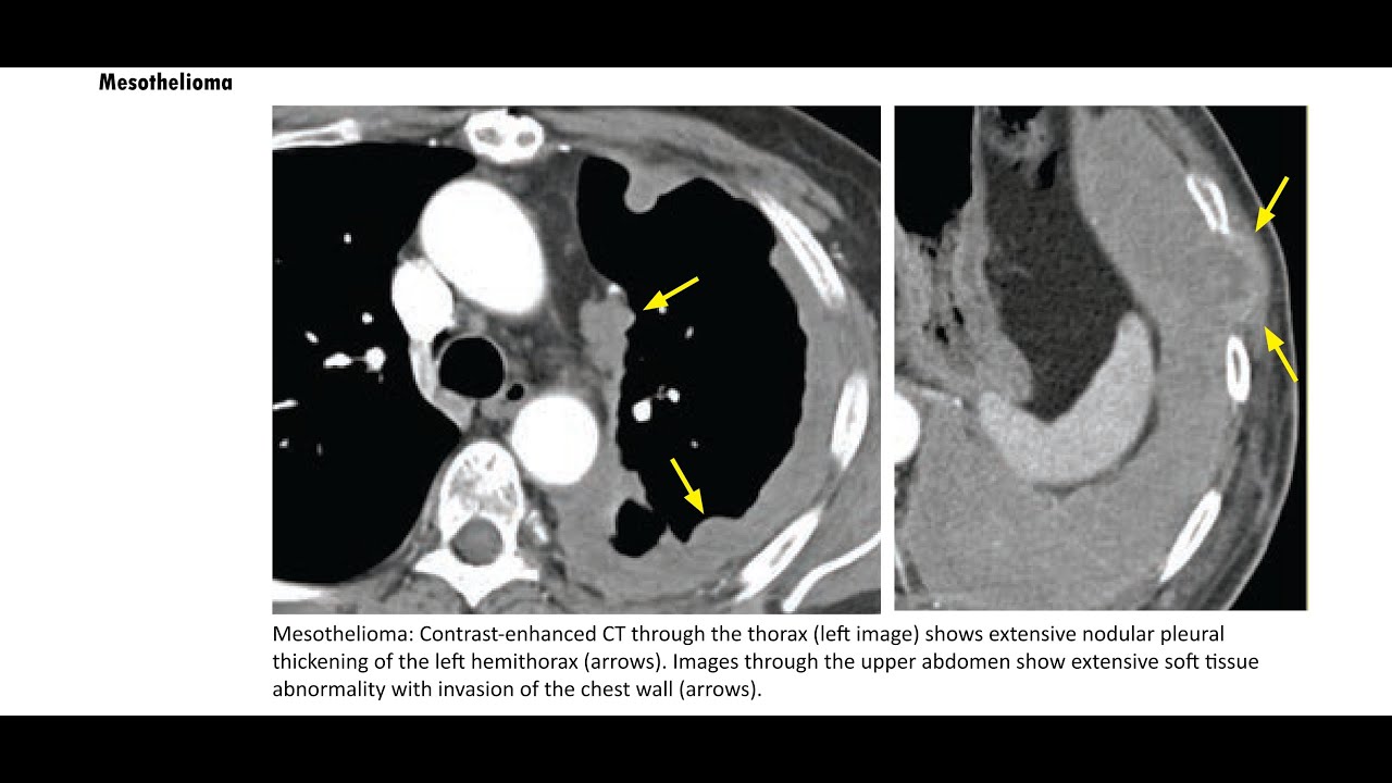 Chest core radiology - YouTube