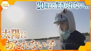 太陽の光を浴びると皮膚がんに…1歳の男の子が患った難病「色素性乾皮症」 息子の未来を探す両親の決意