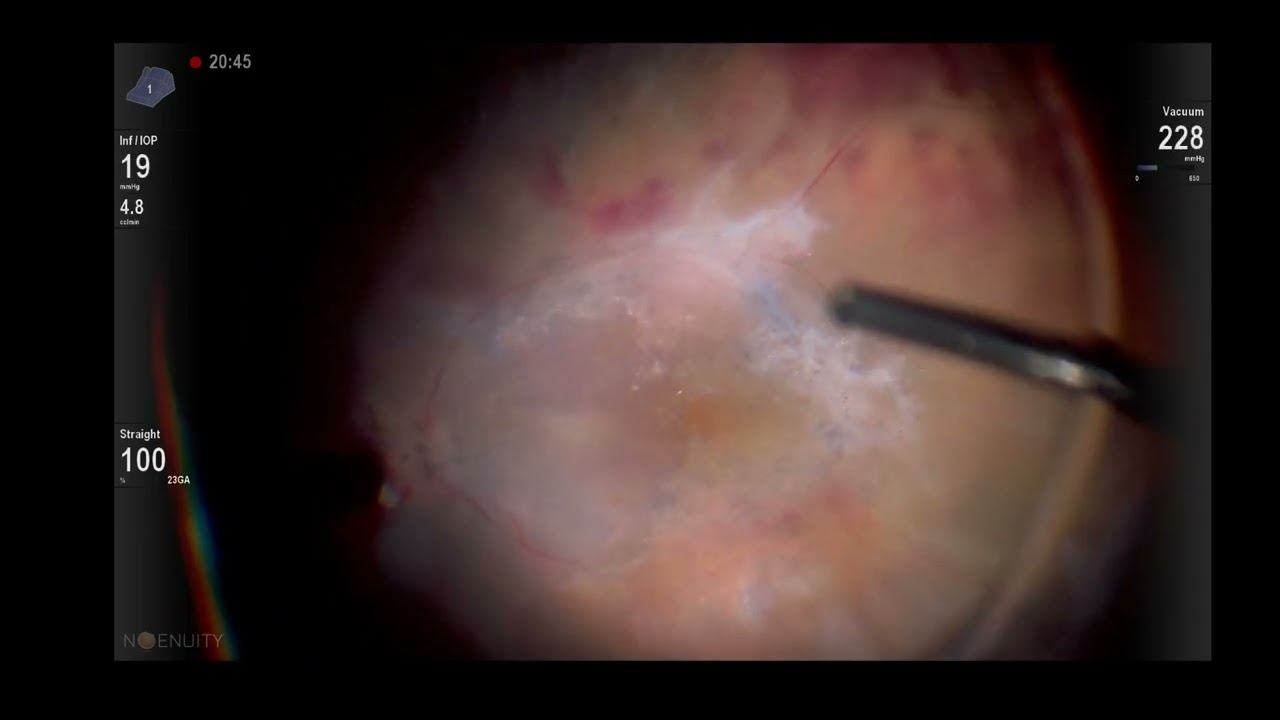 Multimodal imaging with Alcon Ngenuity 3D system Lukan Mishev Live stream