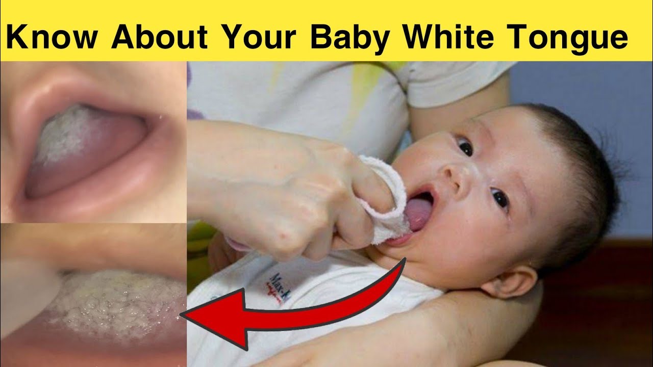 How to Clean Your Baby's Tongue Oral Thrush Or Baby White Tongue